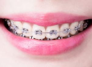 T_0318_braces-orthodontics_923539956.width-320.jpg