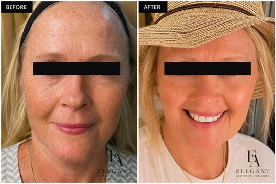 Before and after aggressive Helix CO2 laser resurfacing showing improvement in wrinkles, pigmentation, and skin texture after one treatment