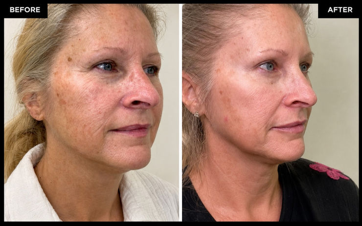CO2 Laser before and after photo at Elegant Aesthetics in Franklin, TN