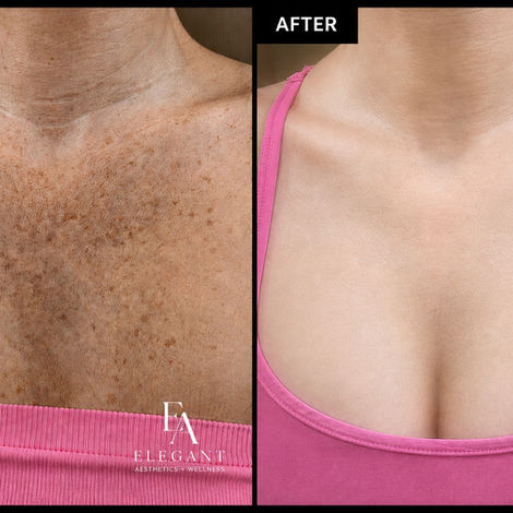 Before and after laser treatment results showing improvement in sun damage and discoloration