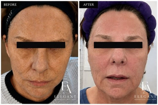 Before and after one intensive Helix CO2 laser treatment at six weeks, showing improvement around the upper eyelids, facial texture, tone, and skin firmness.