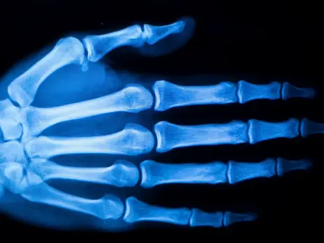 Image of a hand under x-ray