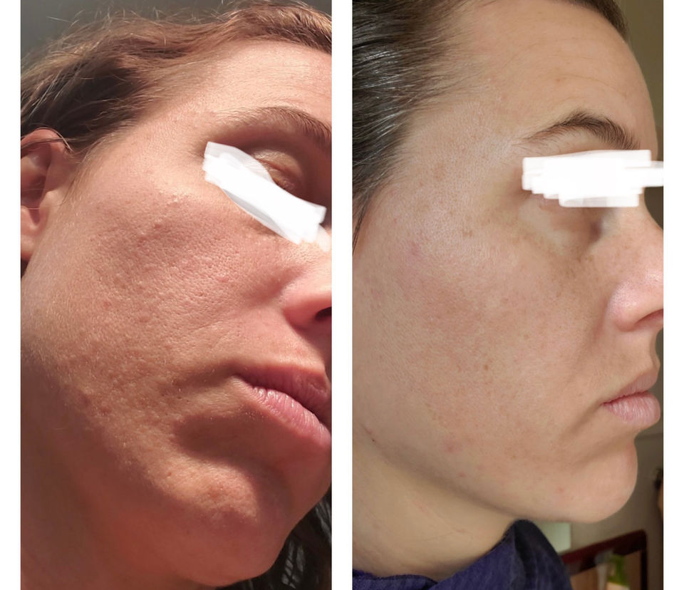 1:1 client acne transformation
