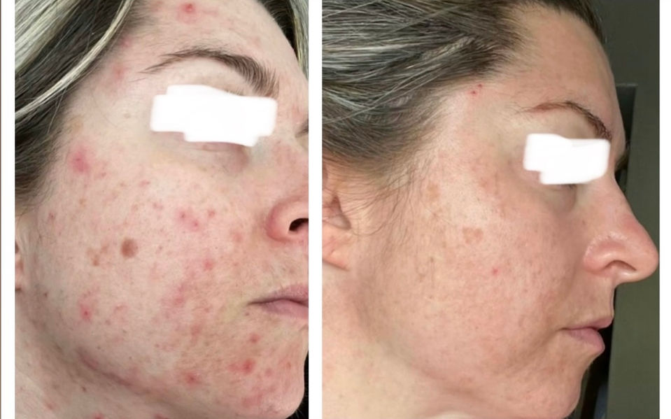 1:1 client acne transformation