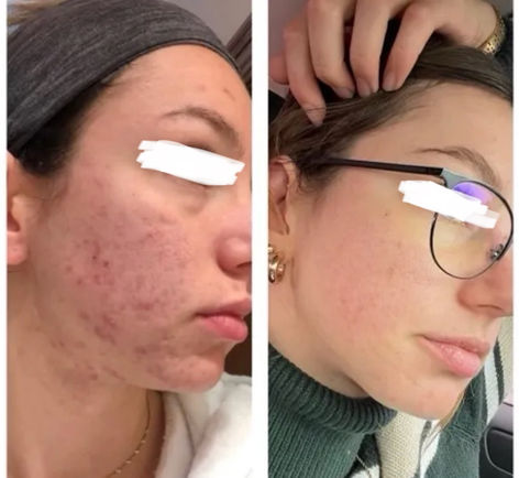 1:1 client acne transformation