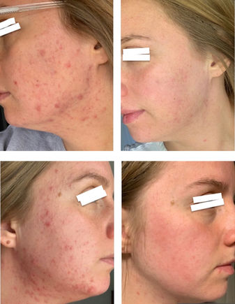 1:1 client acne transformation