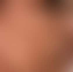 Understanding Pigmentation: Types and Treatments at InnaSkin