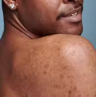 Post-Inflammatory Hyperpigmentation (PIH)