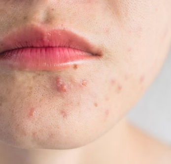 Inflamed papules associated with acne
