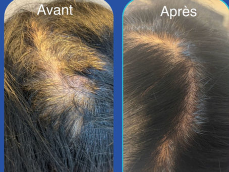 PRP capillaire : pour qui et quels résultats attendre ?
