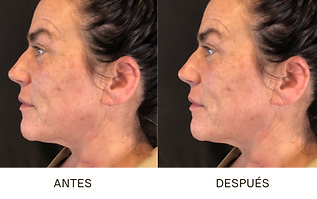 antes y despues-endolift-dos.png