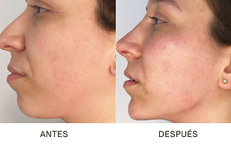 antes y despues-endolift.png