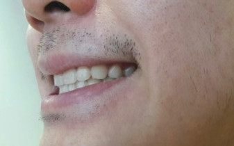 GIKO Smile clinical case