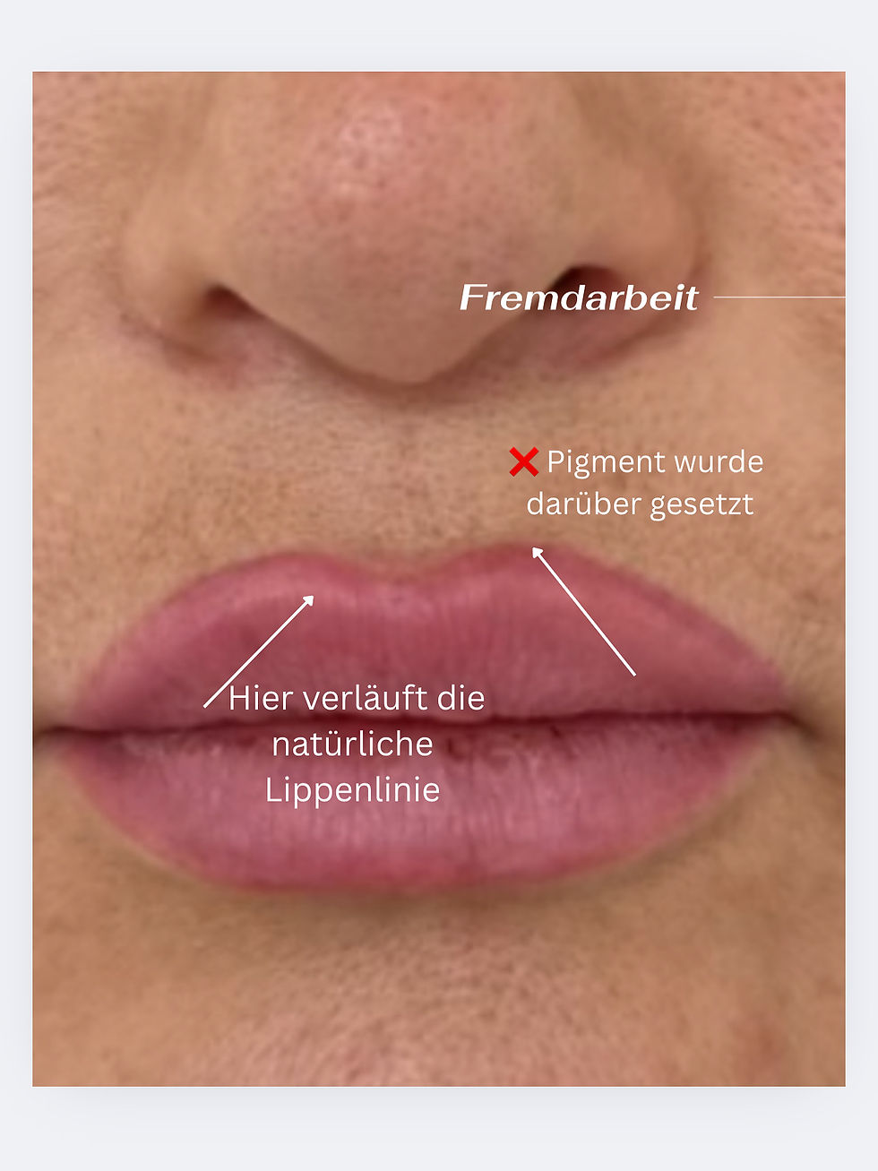 Warum die natürliche Lippenlinie so wichtig ist – und was passiert, wenn man sie zu sehr vergrößert