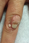 www.havannas.co.uk - Wart on finger
