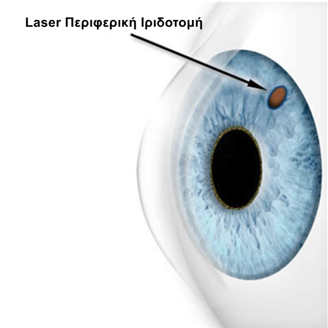 YAG Laser Περιφερική Ιριδοτομή