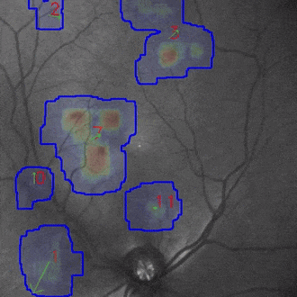PulseMedica-Floater ML Tracking Heatmap Clip-Web.gif