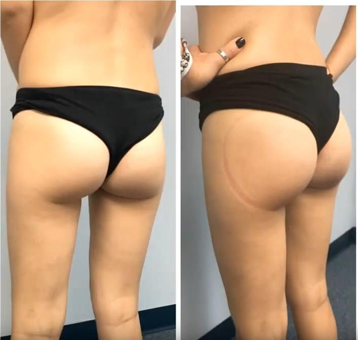 Thumbnail: Vacuum Therapy Machine Enhance Cellulite Treatment Cupping Device
