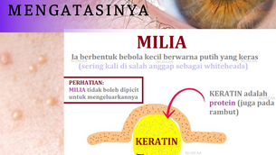 [QUICK INFO] MASALAH MILIA DAN CARA MENGATASINYA