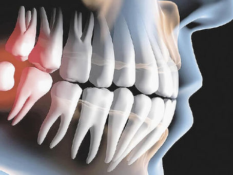 Por que extraÃmos o siso tão cedo?