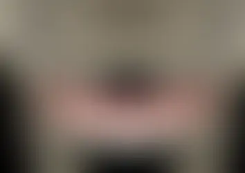 Implantes Zigomáticos: a solução moderna para maxilas atróficas