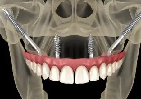 Implantes Zigomáticos: a solução moderna para maxilas atróficas