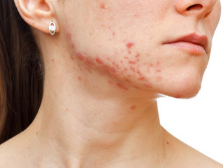 How To Clear and Prevent Acne - Professional Treatments That Work Fast