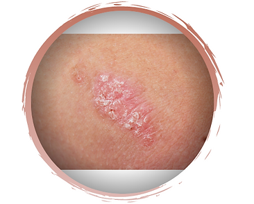 טיפול בפסוריאזיס-גליה יהודה-הבית לנטורופתיה במודיעין