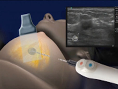 "Y LA CIENCIA AVANZARA":ISRAEL: CONGELAN Y DESTRUYEN TUMORES DE CANCER DE MAMA EN 10 MINUT