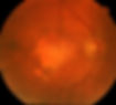 Age Related Macular Degneration