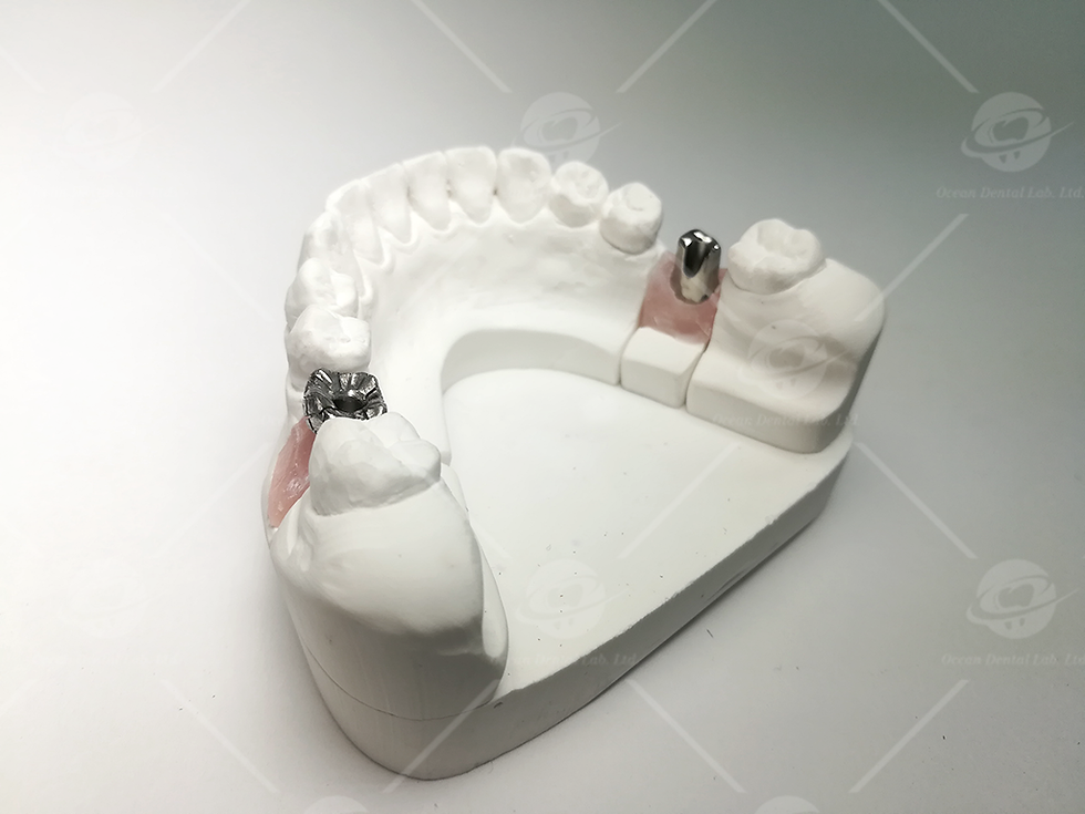 Implant oceandentallab
