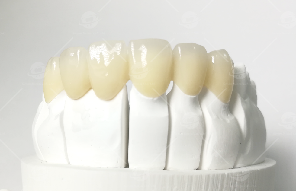 Noritake Zirconia bridge