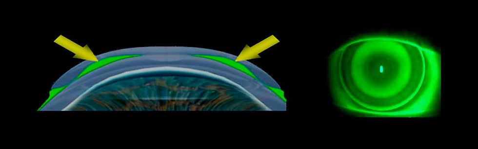 Amoldamiento corneal por Orto-K