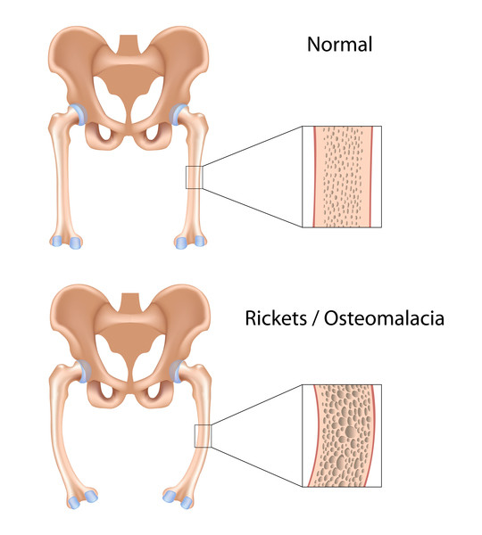 osteomalacia