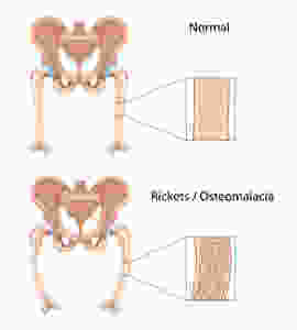 osteomalacia