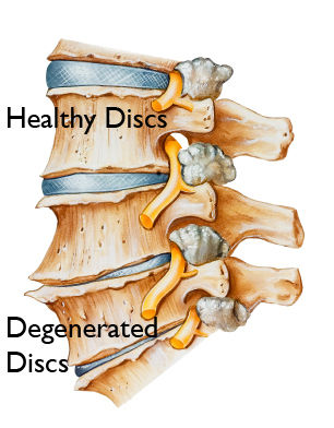 Degenerative Disc Disease (DDD)