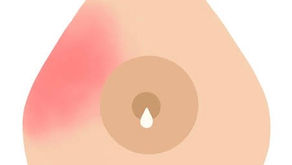 3 astuces pour soulager une mastite en douceur