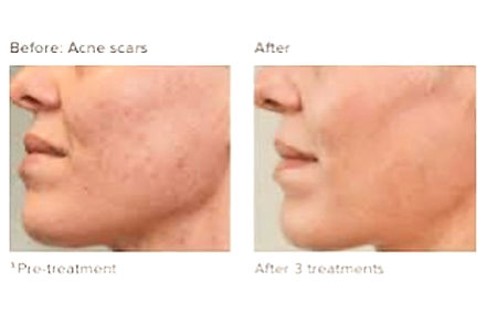 Acne Collagen Induction Therapy - Micro Needling Before and after shots