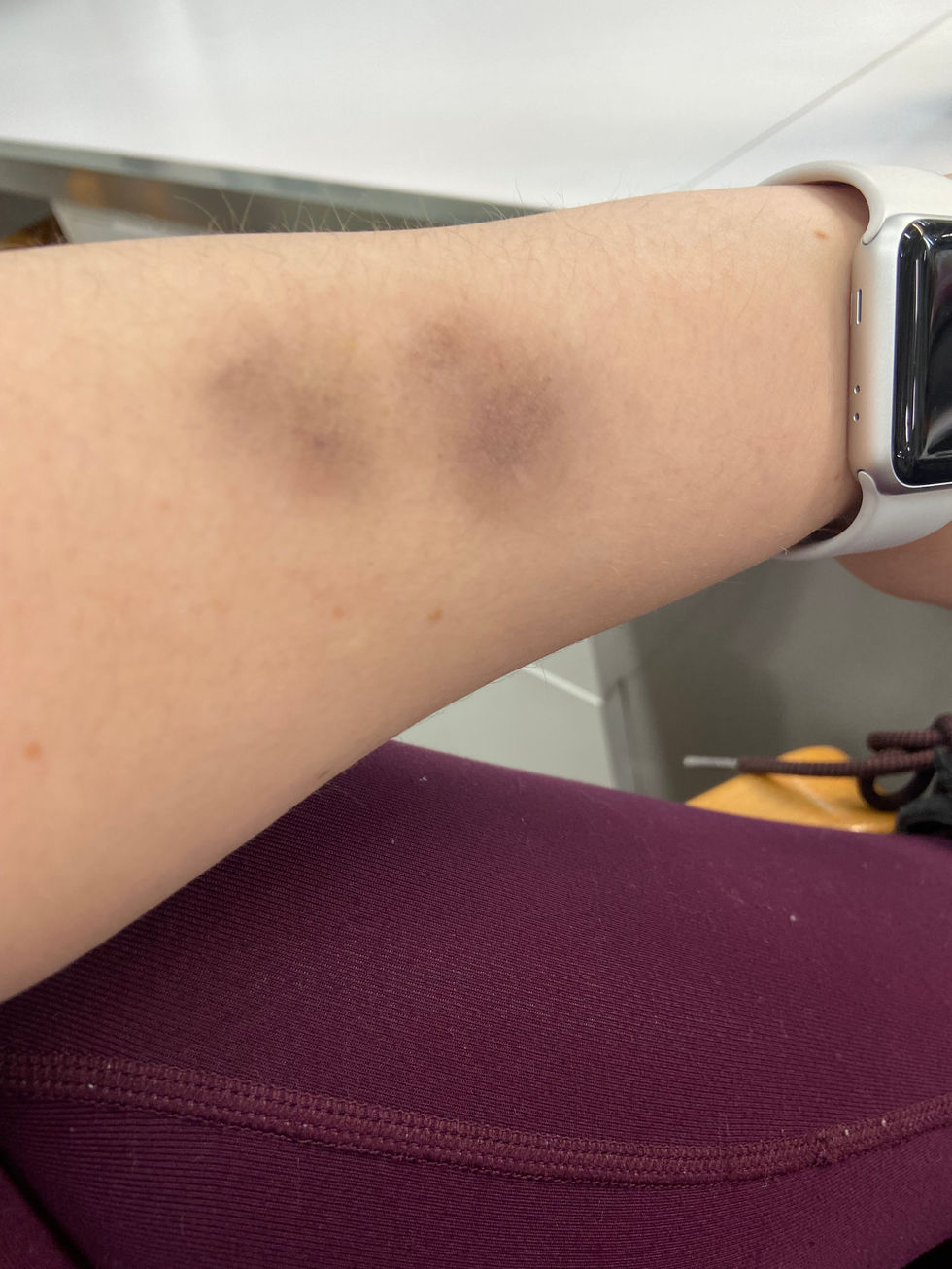 Bruising
