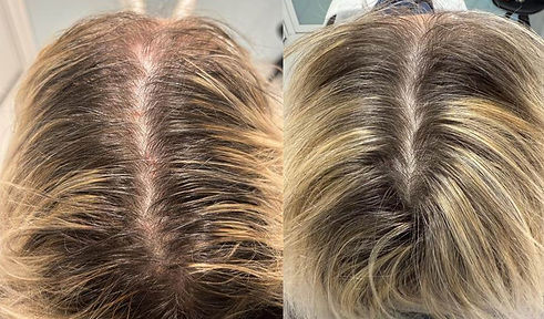 Diffuse alopecia.jpg