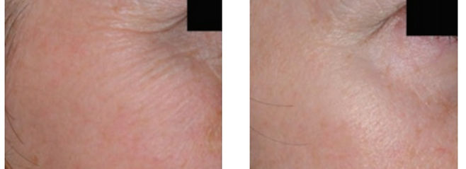 Behandeling met de Sisneo Revicell Radiofrequentie behandeling voor en na