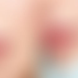 lip filler