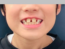 乳歯_歯並び