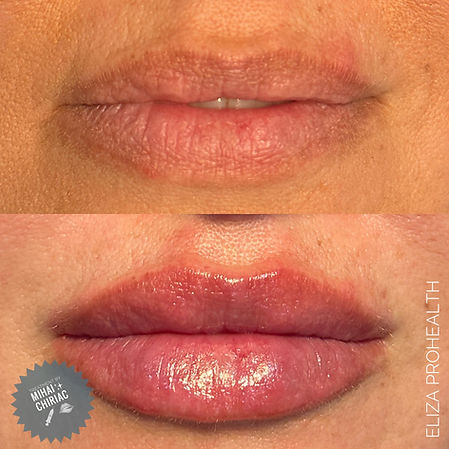 Lip filler 1ml Volift