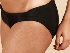 Les vergetures vous préoccupent ? Découvrez nos astuces infaillibles pour les éliminer !