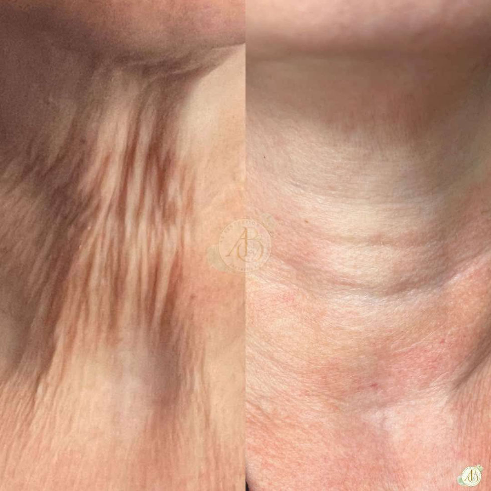 Polynucleotides on the neck - before and after