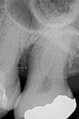Dallas, DFW, Coppell periodontist, Gum disease, Regeneration, Dr. Ted Ling, Dr. Jenny Tai