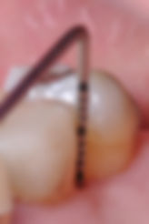 Dallas, DFW, Coppell periodontist, Gum disease, Regeneration, Dr. Ted Ling, Dr. Jenny Tai
