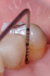 Dallas, DFW, Coppell periodontist, Gum disease, Regeneration, Dr. Ted Ling, Dr. Jenny Tai