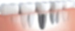 Dental implant